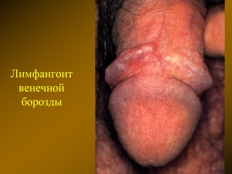 Лимфангоит венечной борозды